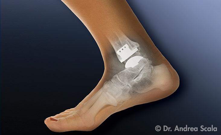 protesi di caviglia cammina