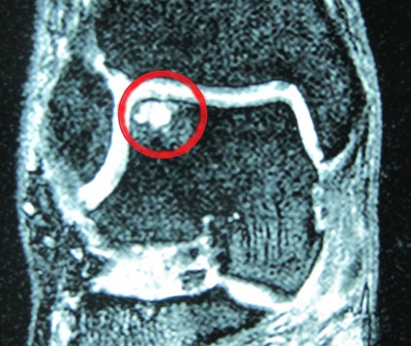 osteocondrosi astragalo