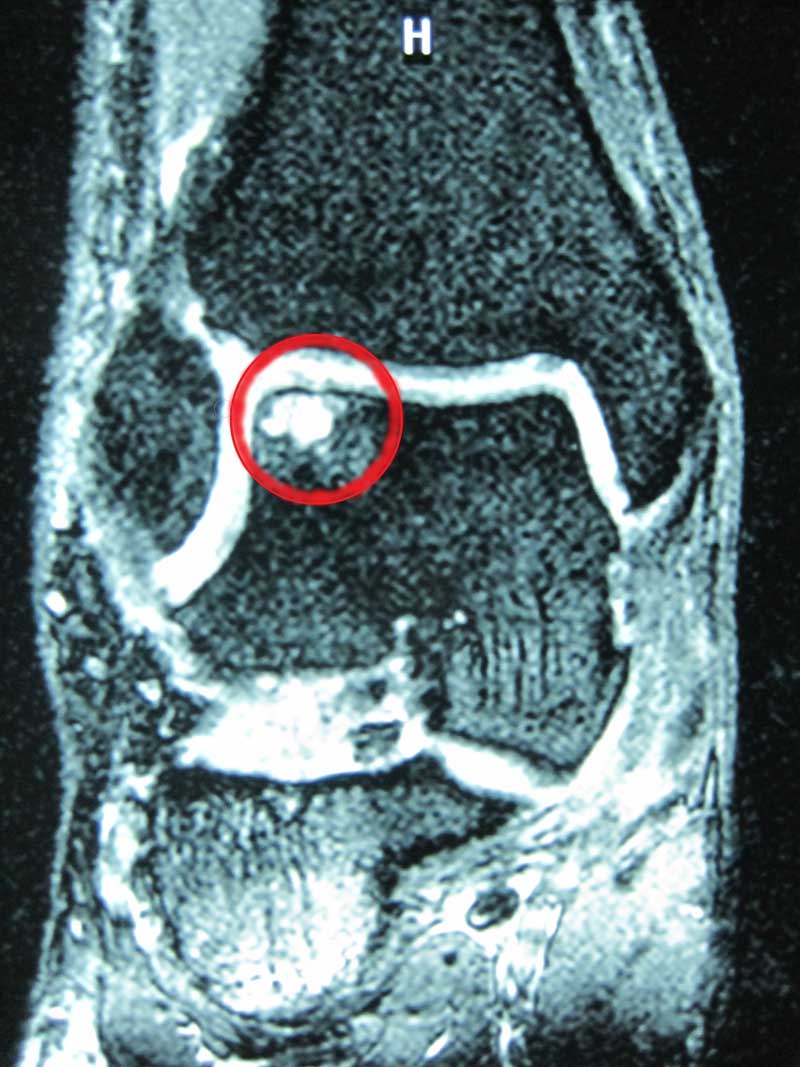 Lesione Osteocondrale Del Condilo Femorale Mediale
