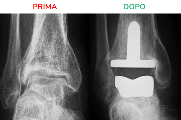 Protesi caviglia