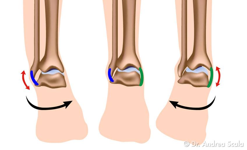 distorsione alla caviglia