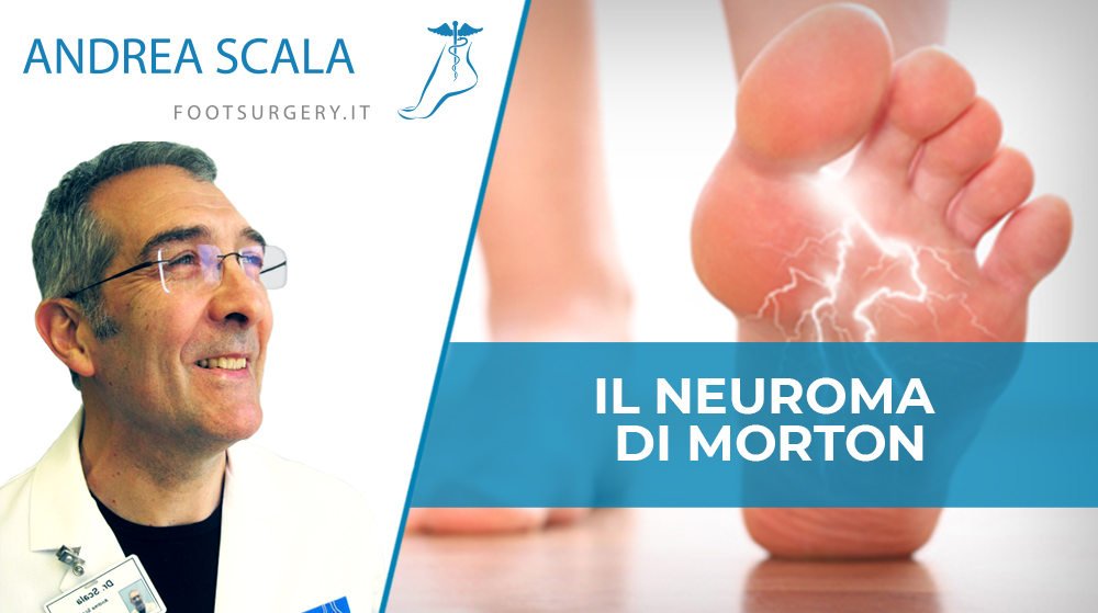 neuroma di Morton