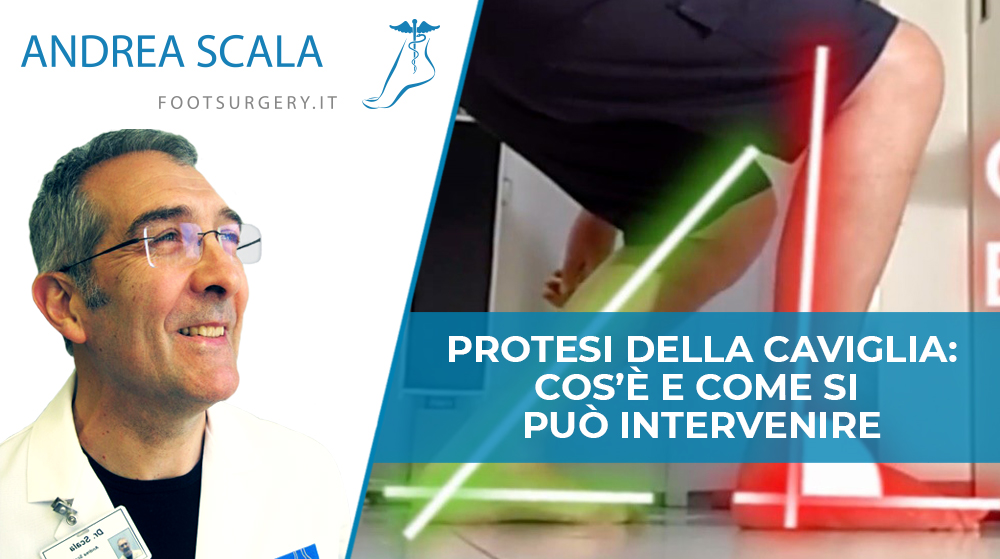 Protesi della caviglia: cos’è e come si può intervenire