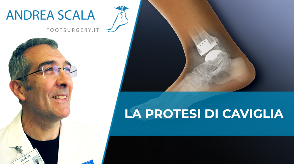 protesi di caviglia dott. Scala