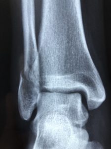 chirurgia protesi caviglia