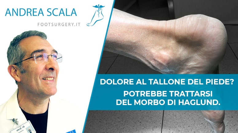 Dolore al tallone? Potrebbe trattarsi del Morbo di Haglund