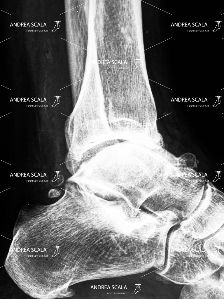 Protesi di Caviglia: intervento e riabilitazione