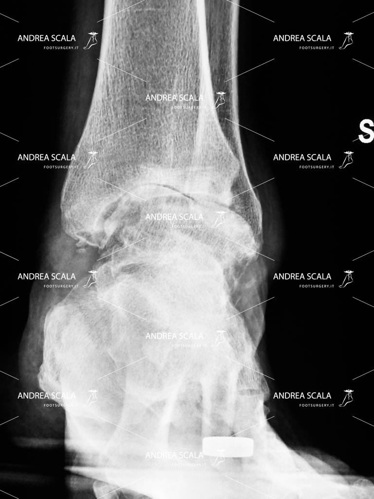 Protesi di Caviglia: cosa dobbiamo sapere prima dell’operazione