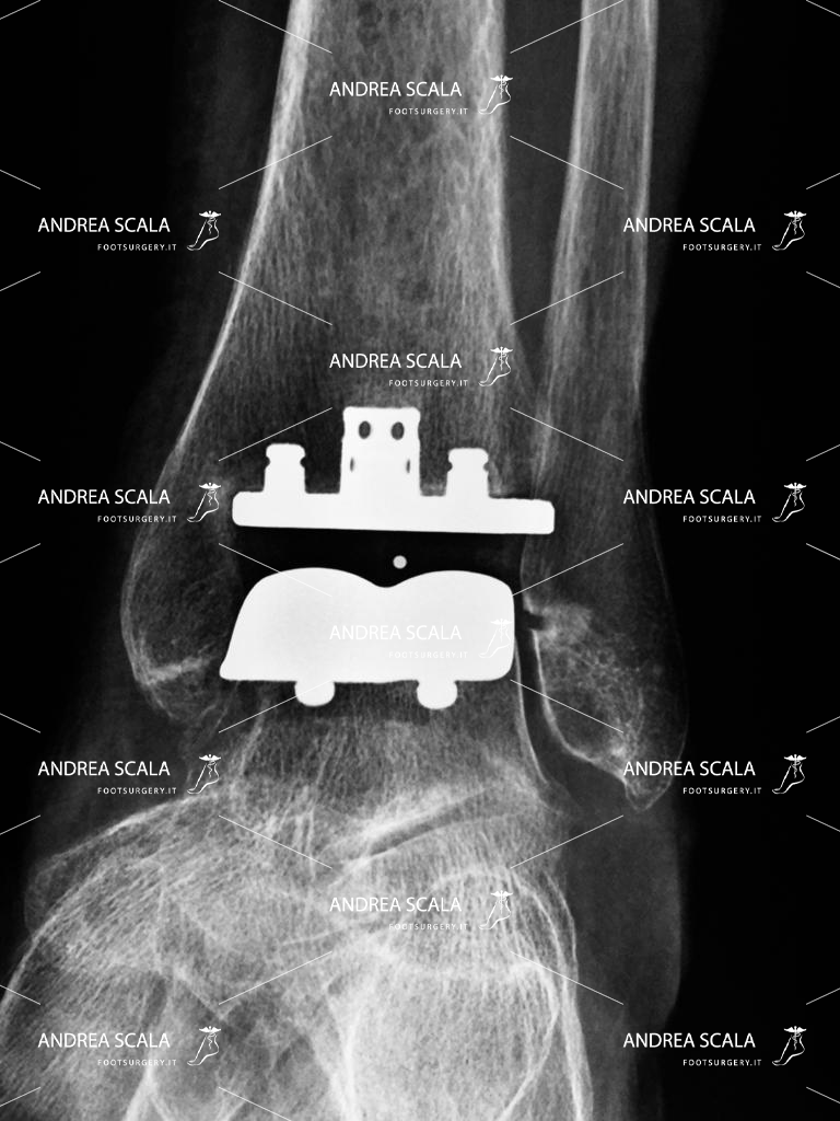 Protesi di Caviglia: intervento e riabilitazione