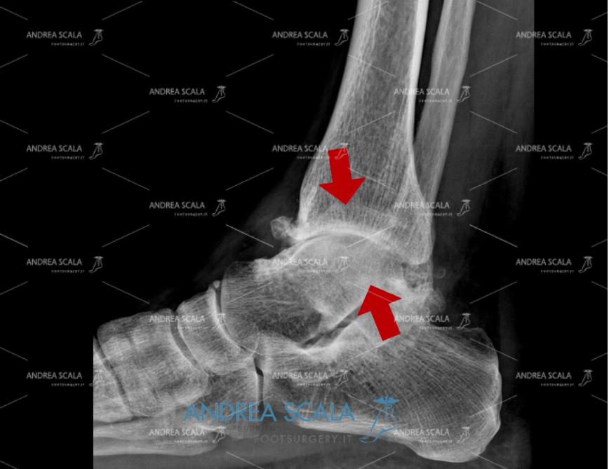 Cartilagine radiografia protesi della caviglia Laterale