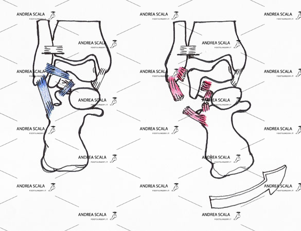 Distorsione della Caviglia