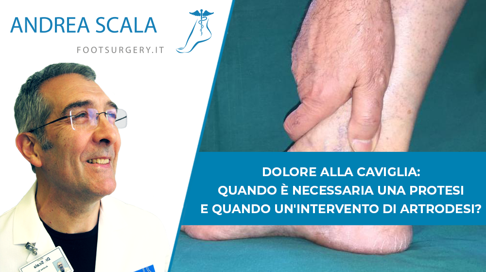 Dolore alla caviglia: artrodesi o protesi?