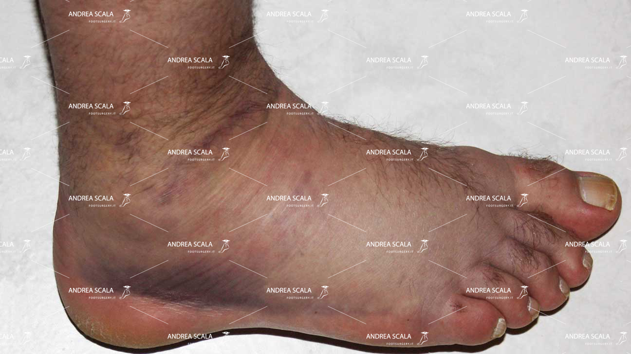 rigidità articolare protesi caviglia