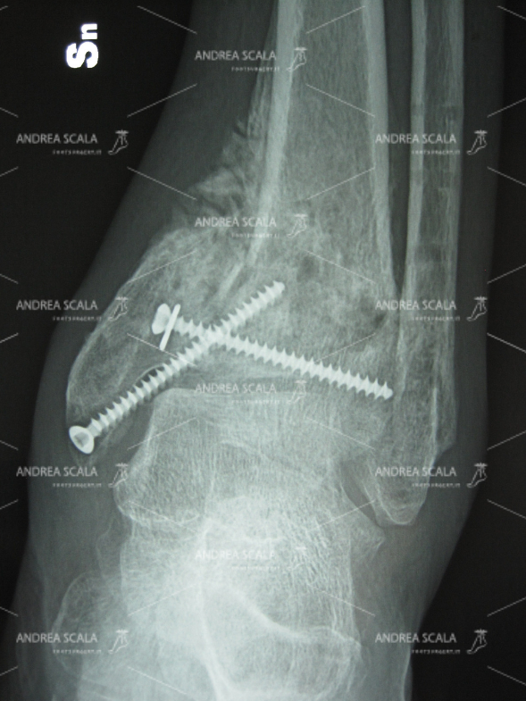 Lesione neurologica Frattura spostata radiografia piede