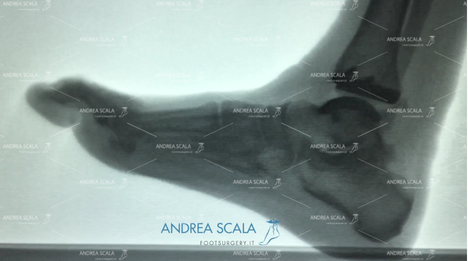 Protesi caviglia radiografia in movimento