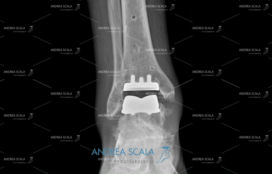 Radiografia di Protesi di caviglia anteriore