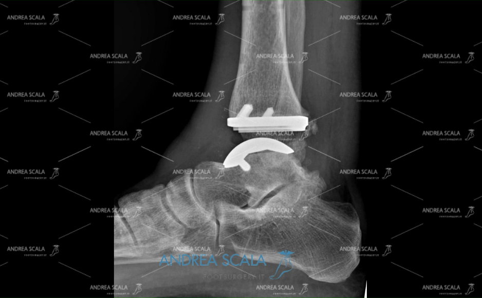 Radiografia Protesi di caviglia laterale