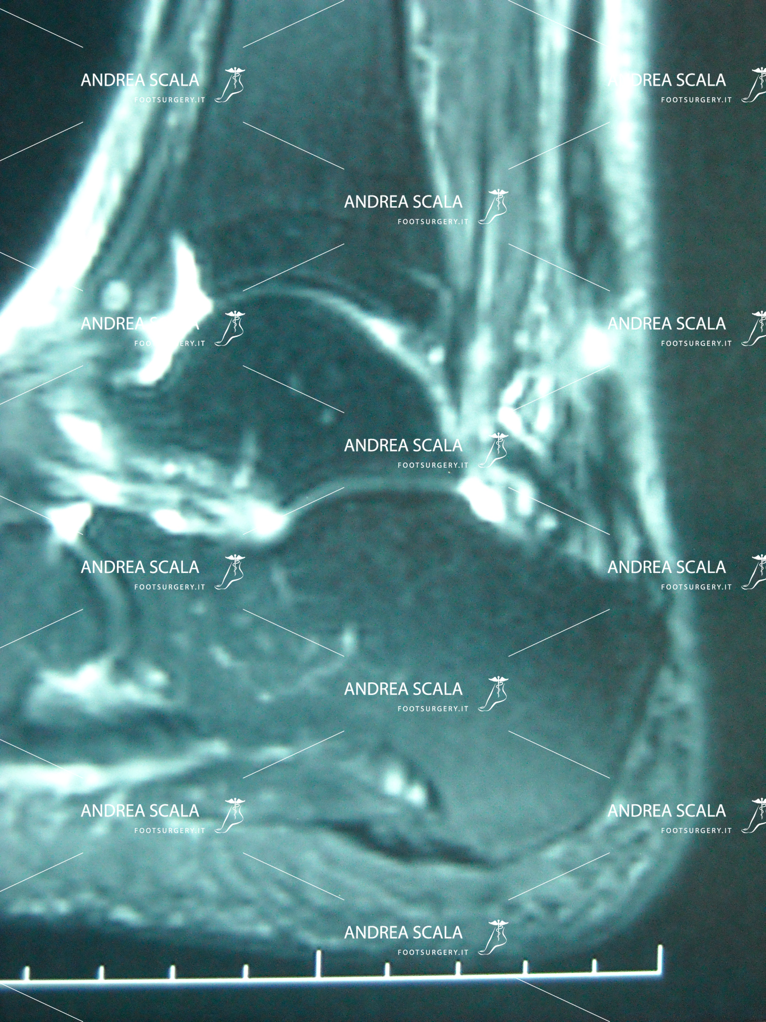 rottura tendine d'Achille: traumatologia e curiosità