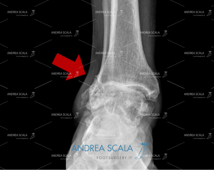 cartilagine radiografia protesi di caviglia anteriore