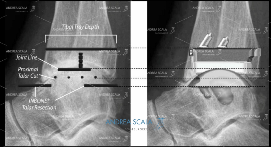 ARTRODESI radiografia laterale doppia