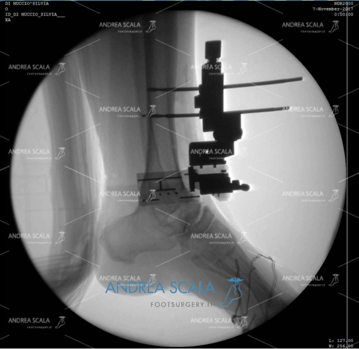 ARTRODESI radiografia laterale post operazione con guide