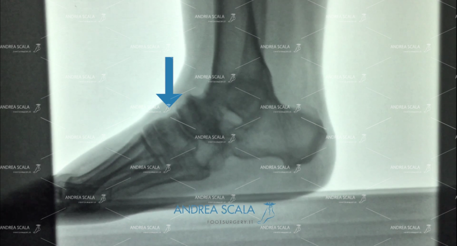 ARTRODESI radiografia laterale scafoide