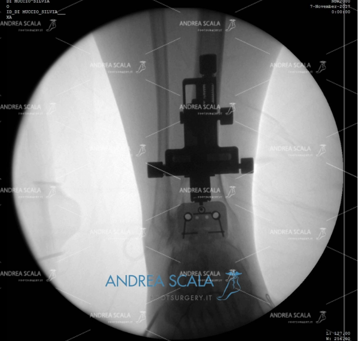 ARTRODESI radiografia posteriore post operazione con guide