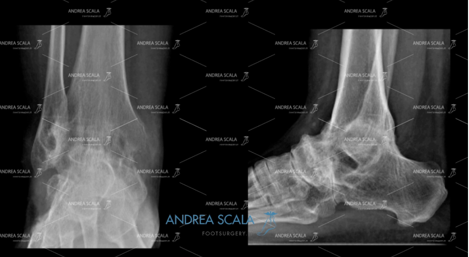 artrodesi radiografie
