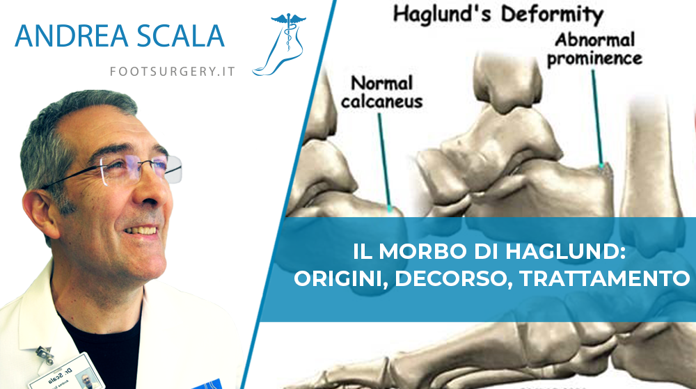 Il Morbo di Haglund: origini, decorso, trattamento