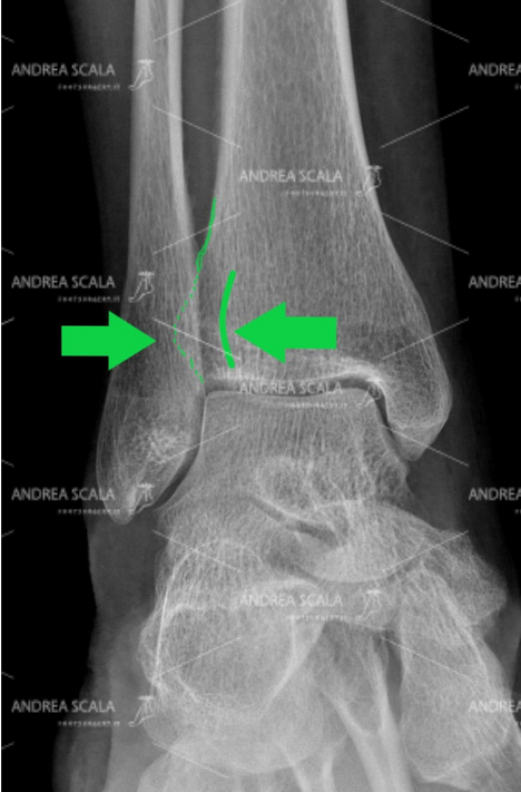 LA PROTESI DI CAVIGLIA ECOLOGICA Radiografia Posteriore Tibia e Perone