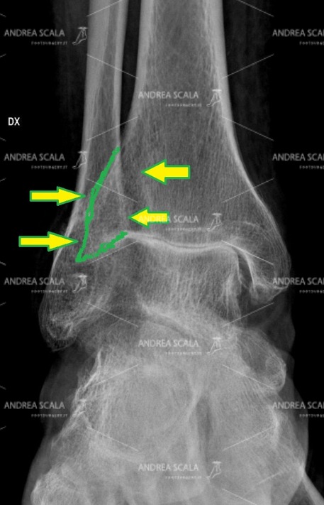 LA PROTESI DI CAVIGLIA ECOLOGICA radiografia posteriore evidenziata 