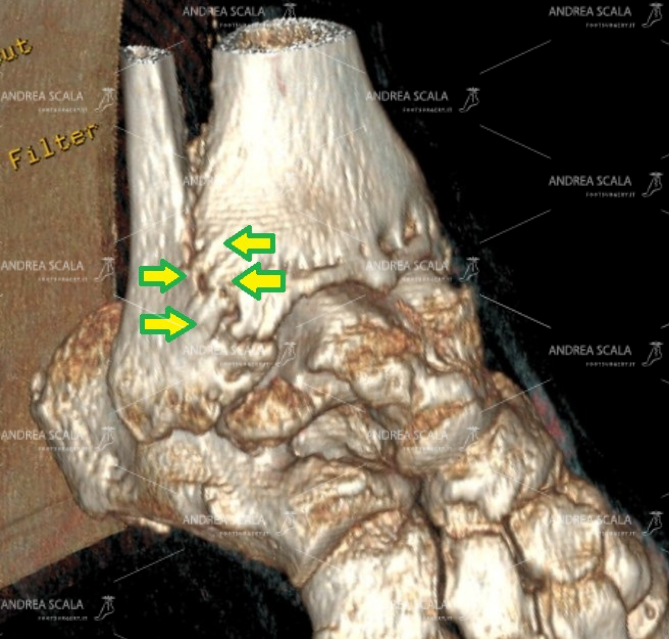 LA PROTESI DI CAVIGLIA ECOLOGICA Tac Multidimensionale Dott. Scala