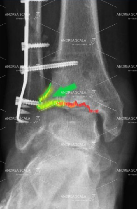 LA PROTESI DI CAVIGLIA ECOLOGICA ponte dopo la frattura radiografia