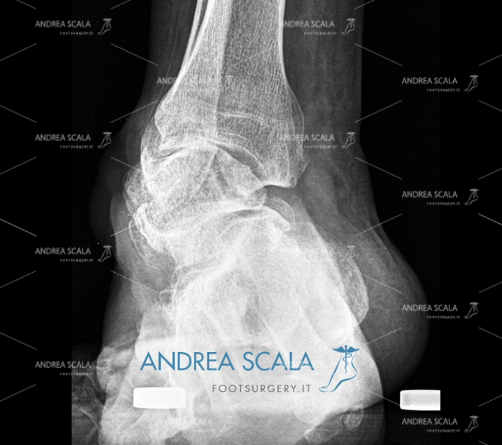 Radiografia Protesi di Caviglia e paralisi 