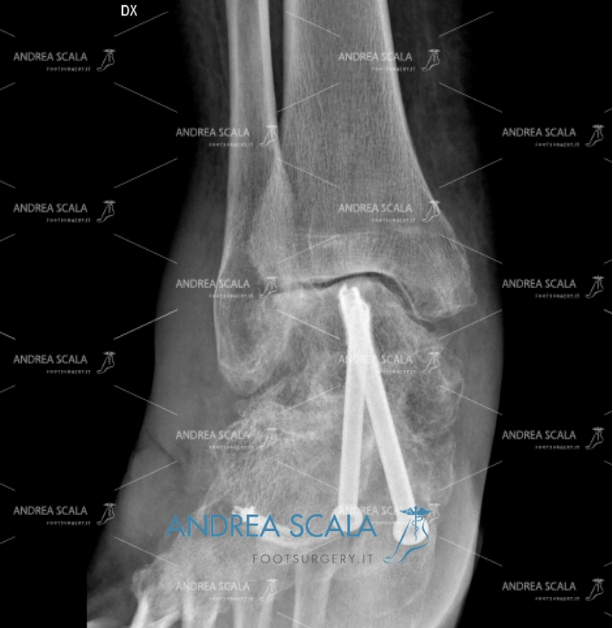 Radiografia Protesi di Caviglia e paralisi operato