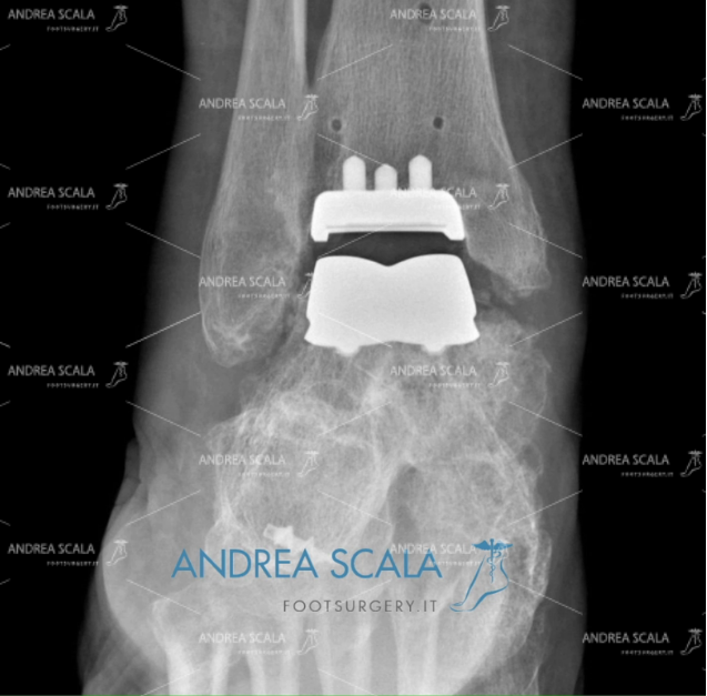 Radiografia Protesi di Caviglia e paralisi uomo 
