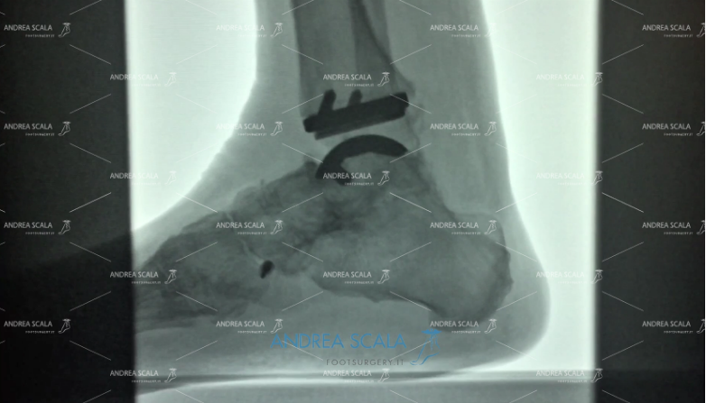 Radiografia finale Protesi di Caviglia e paralisi uomo risultati