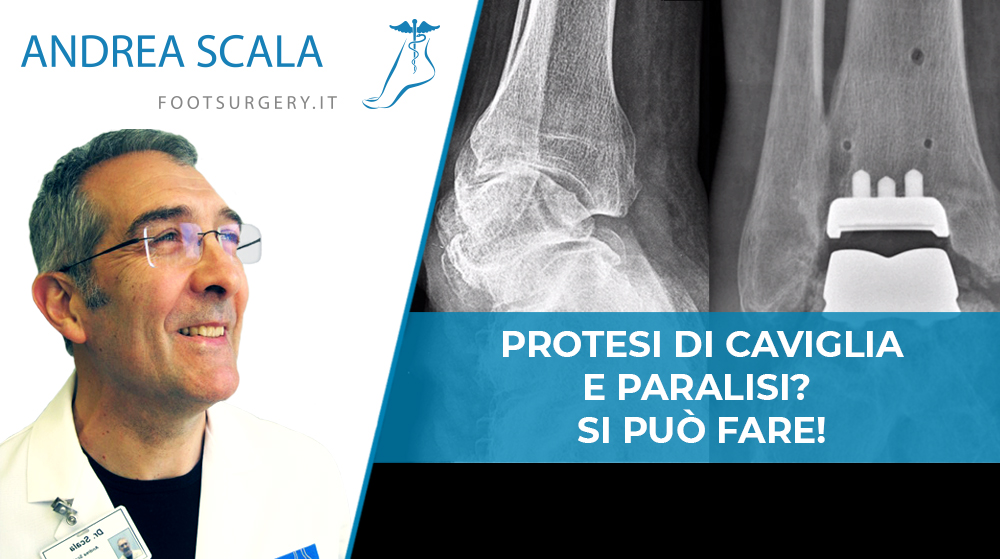 Protesi di Caviglia e paralisi dott. Scala