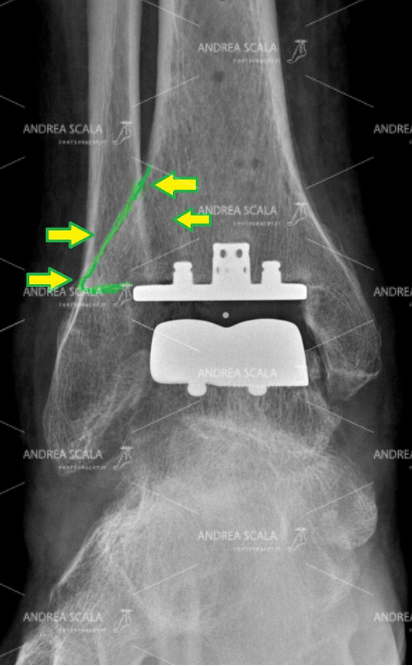 LA PROTESI DI CAVIGLIA ECOLOGICA radiografia post operazione