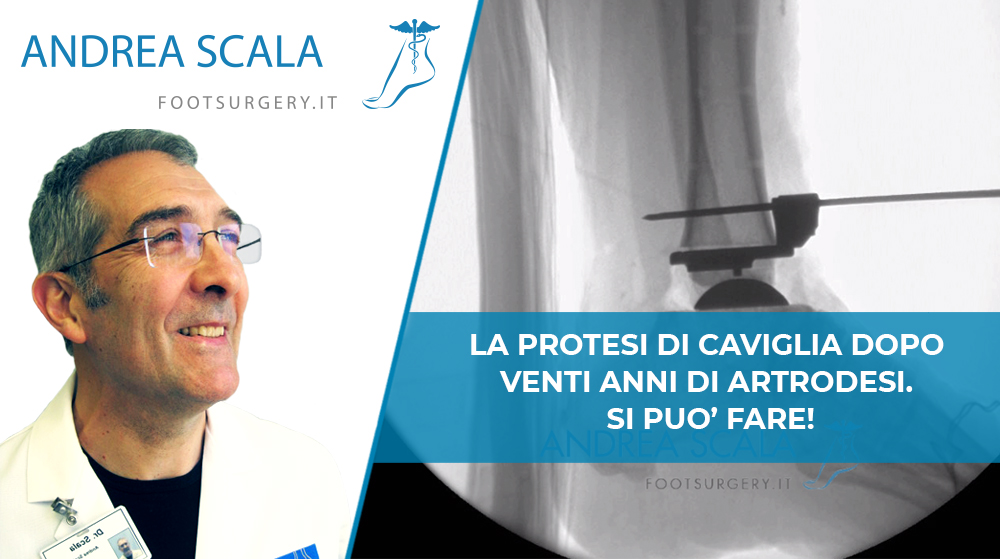 Artrodesi: come superarla con la protesi di caviglia.