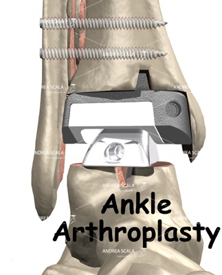 protesi caviglia