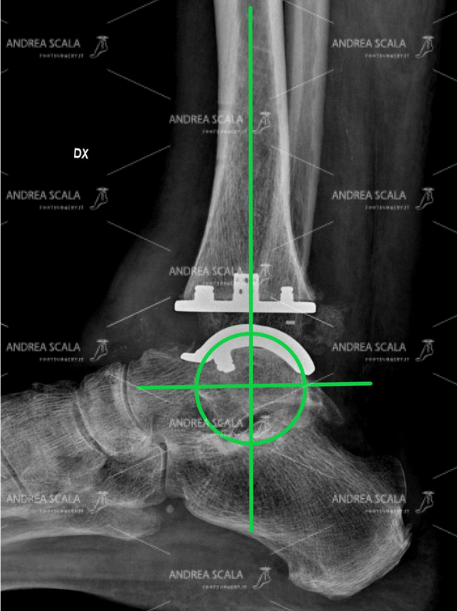 taglio del Perone centro di rotazione in radiografia