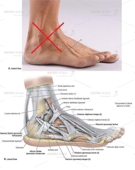 Non si dovrebbe accedere alla caviglia per via laterale perché si dovrebbe tagliare il perone, divaricare i tendini peroneali e il nervo surale. Si divrebbero tagliare i legamenti laterali e staccare il perone dalla sindesmosi tibio-peroneale distale.
