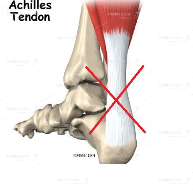 Non si accede alla caviglia per via posteriore perché si dovrebbe tagliare il tendine d’Achille.