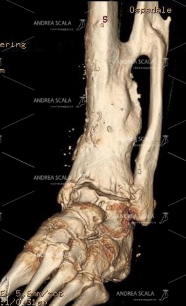 La TAC 3D mostra la grave artrosi della caviglia dopo la frattura. I malleoli sono guariti. La protesi della caviglia deve sostituire l’articolazione malata con l’accesso anteriore. Non c’è alcun bisogno di rompere nuovamente il perone.