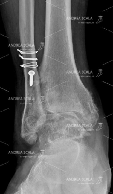 La RX anteriore mostra la guarigione della frattura del perone. La caviglia soffre per la artrosi della caviglia, ma ha recuperato la stabilità.