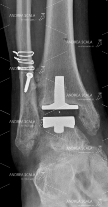 La protesi di caviglia consente il movimento articolare, ma non ha toccato il malleolo peroneale. La stabilità della caviglia non è stata compromessa.
