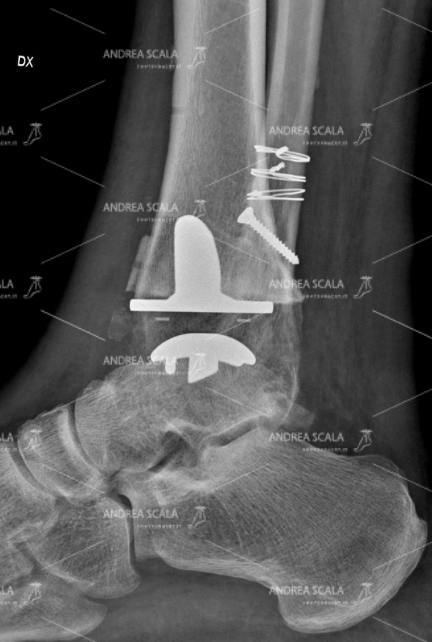 Si vede che la protesi della caviglia ha ripristinato lo spazio articolare. Il perone non è stato toccato.