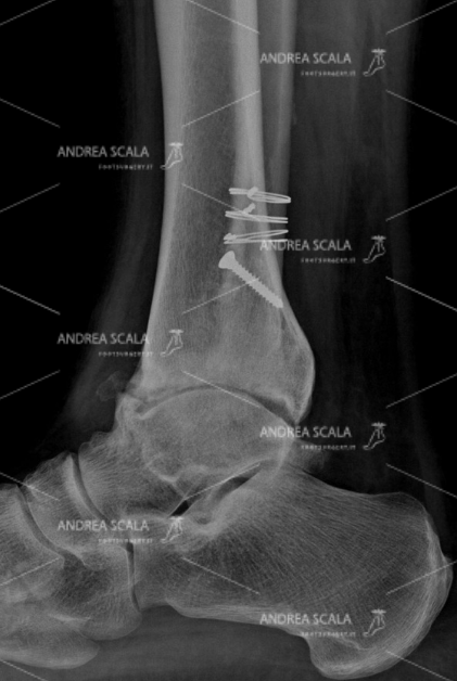 La RX laterale mostra la artrosi della caviglia e la guarigione della frattura del perone