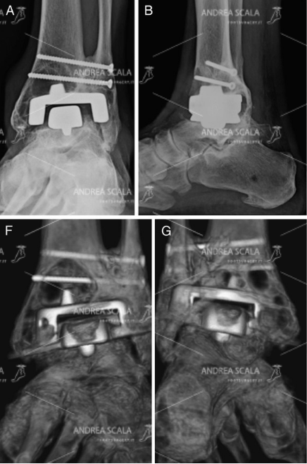 Le immagini radiologiche e TAC mostrano le cavità e i forami provocati dalla protesi americana. Il paziente rimane quasi senza osso.